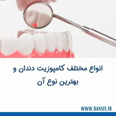 انواع مختلف کامپوزیت دندان و بهترین نوع آن